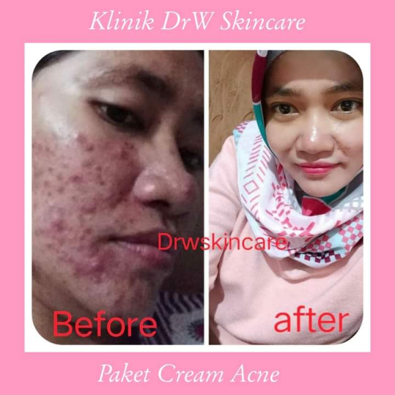 PAKET RADIANT ACNE